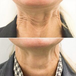 neckbigger
